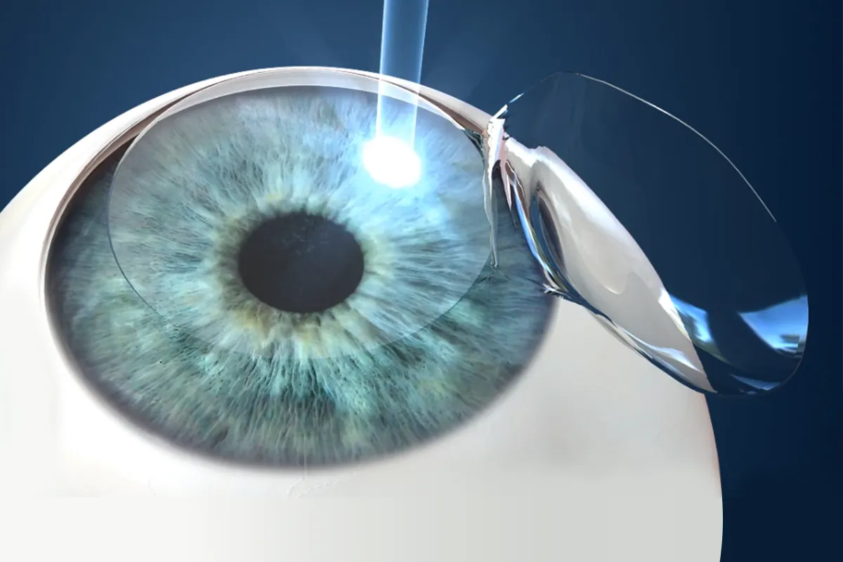 Cirurgia Refrativa LASIK: Visão Nítida com Recuperação Rápida