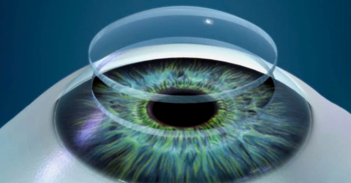 Transplante de Córnea Penetrante (Ceratoplastia): Uma Nova Chance para a Visão