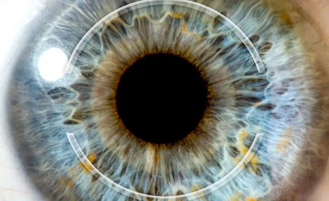 Anel de Ferrara com Laser de Femtossegundo: Tecnologia Avançada para Tratar o Ceratocone