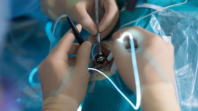 Vitrectomia Posterior: A Microcirurgia que Salva a Visão em Doenças da Retina e do Vítreo